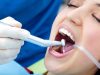Ini Loh 5 Cara Mencegah dan Menghilangkan Karang Gigi