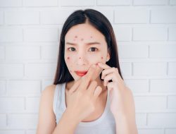 6 Tutorial Mencegah Munculnya Jerawat yang Berlebihan